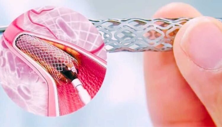 Cardiac stent price capped by NPPA